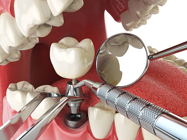 Best Emergency Tooth Extraction in Parshall, ND